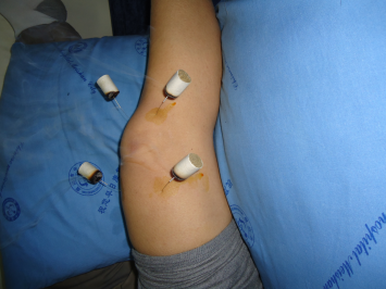 (温针灸治疗)(小夹板外固定术)(肩关节松动术)(小针刀松解术)(特色